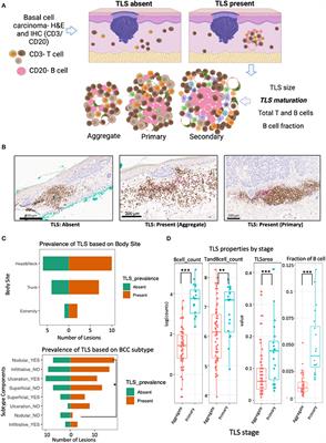 Tertiary lymphoid structures accompanied by fibrillary matrix morphology impact anti-tumor immunity in basal cell carcinomas